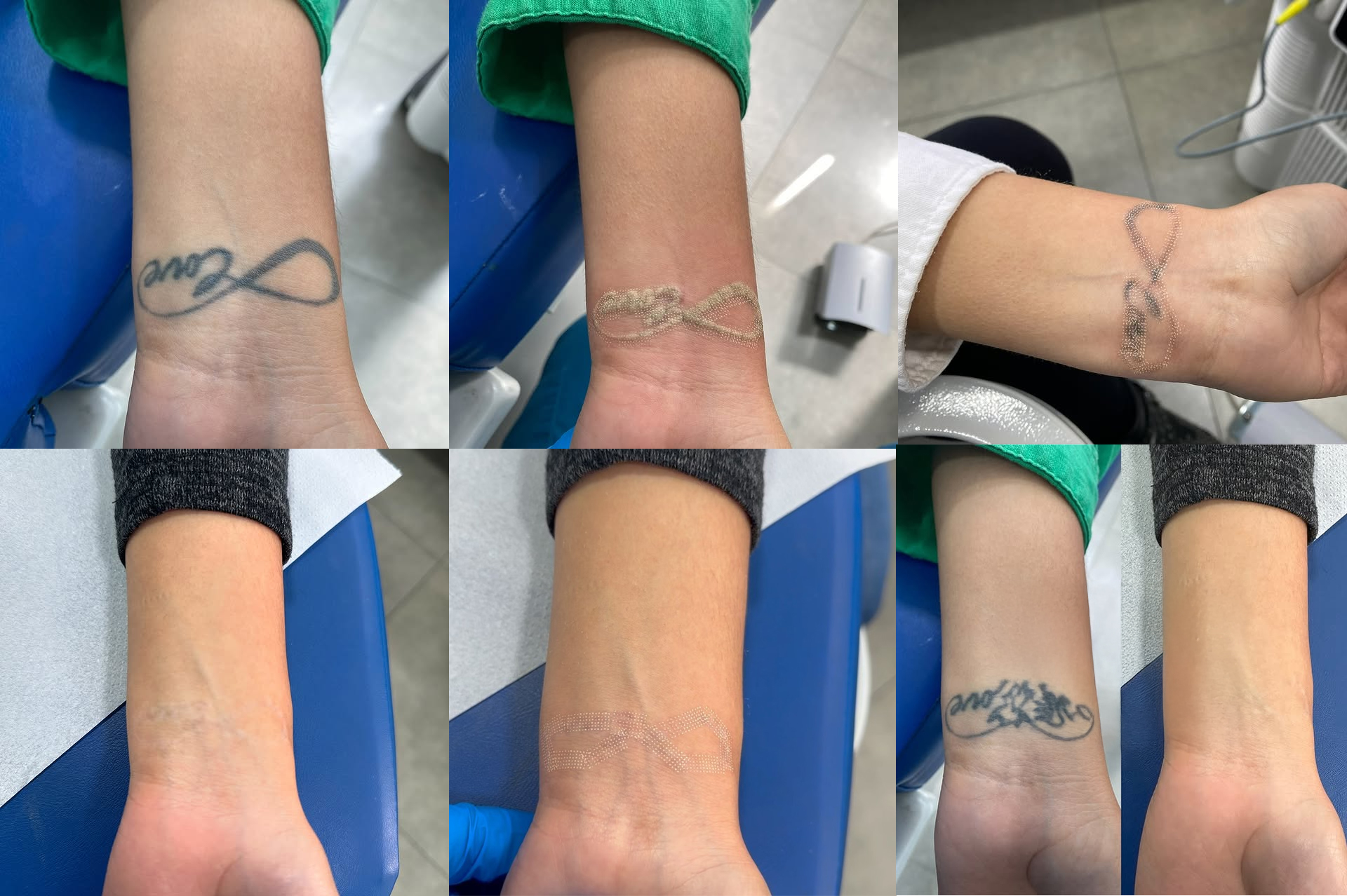 Laser Tattoo Removal