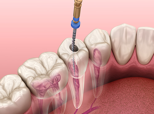 advance-root-canal-service