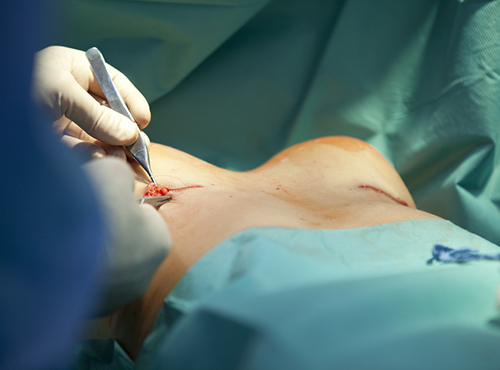 breast-surgery-service