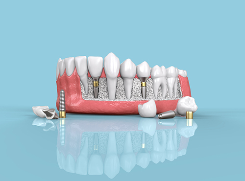 dental-implants-treatment.php