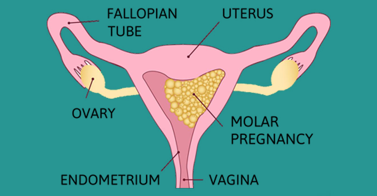 molar-pregnancy.jpg