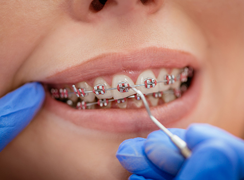 orthodontic-braces-service