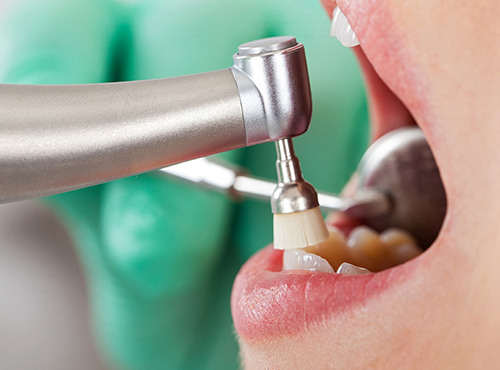 scaling-and-polishing-teeth-service
