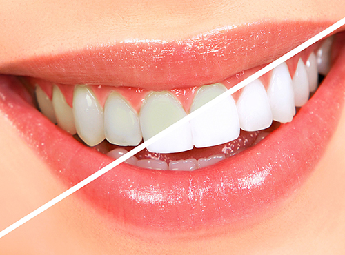 teeth-whitening-service