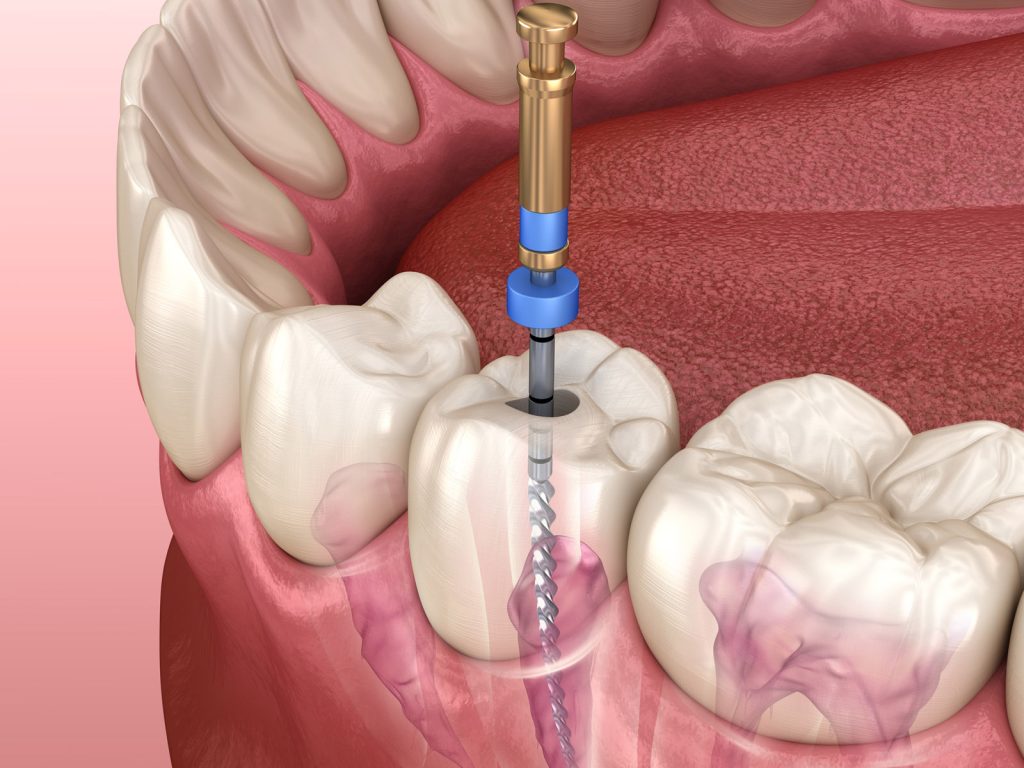 The Process of Root Canal Treatment