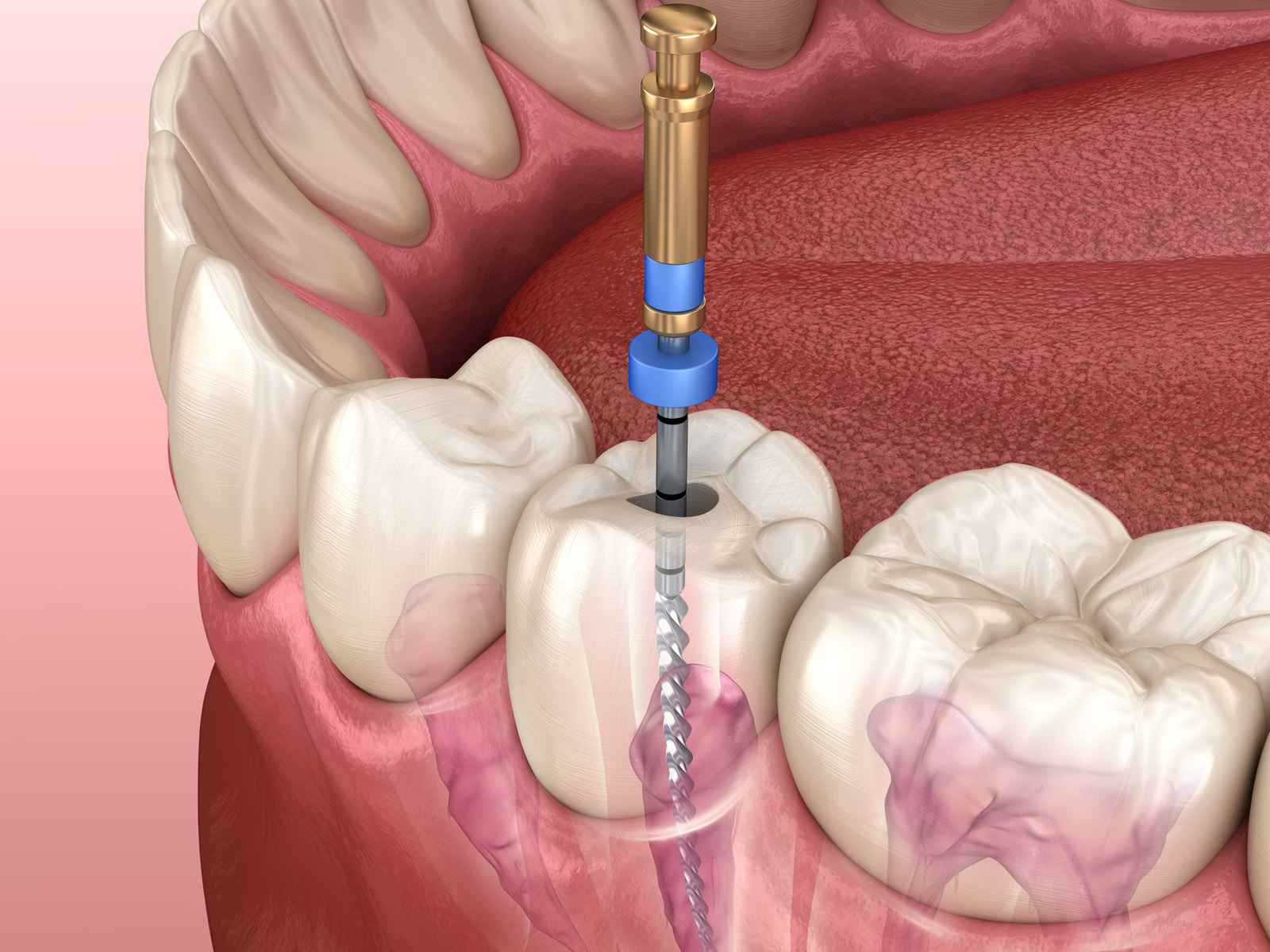 Root canal treatment in Pune